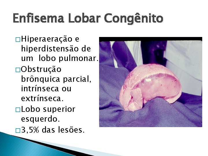Enfisema Lobar Congênito � Hiperaeração e hiperdistensão de um lobo pulmonar. � Obstrução brônquica