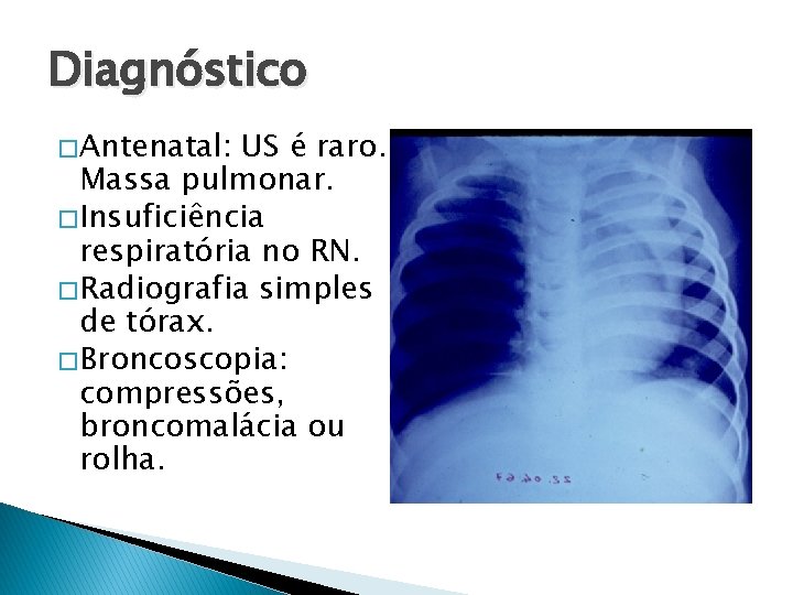 Diagnóstico � Antenatal: US é raro. Massa pulmonar. � Insuficiência respiratória no RN. �
