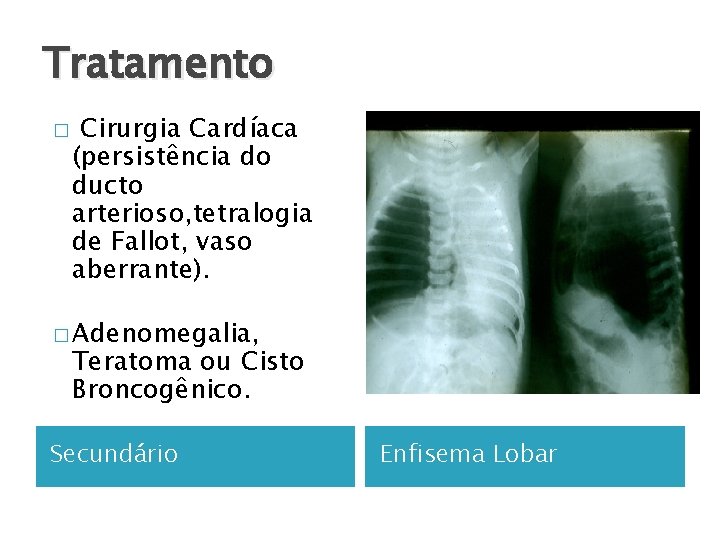 Tratamento � Cirurgia Cardíaca (persistência do ducto arterioso, tetralogia de Fallot, vaso aberrante). �