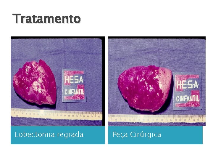 Tratamento Lobectomia regrada Peça Cirúrgica 