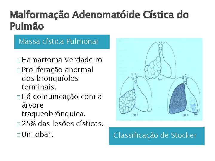 Malformação Adenomatóide Cística do Pulmão Massa cística Pulmonar � Hamartoma Verdadeiro � Proliferação anormal