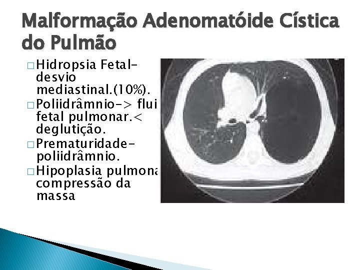 Malformação Adenomatóide Cística do Pulmão � Hidropsia Fetal- desvio mediastinal. (10%). � Poliidrâmnio-> fluido