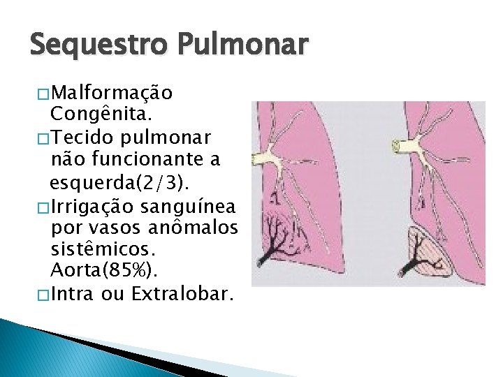 Sequestro Pulmonar � Malformação Congênita. � Tecido pulmonar não funcionante a esquerda(2/3). � Irrigação
