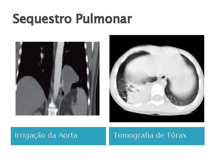 Sequestro Pulmonar Irrigação da Aorta Tomografia de Tórax 