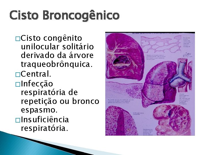 Cisto Broncogênico � Cisto congênito unilocular solitário derivado da árvore traqueobrônquica. � Central. �