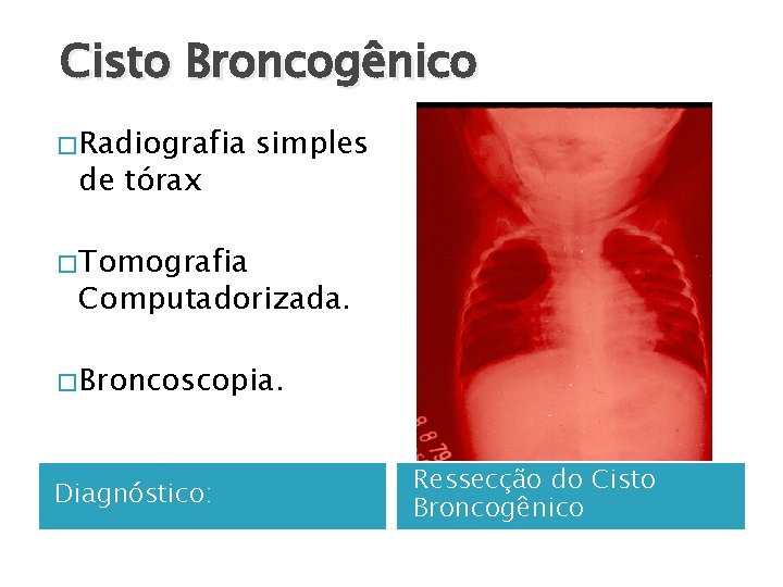 Cisto Broncogênico � Radiografia de tórax simples � Tomografia Computadorizada. � Broncoscopia. Diagnóstico: Ressecção