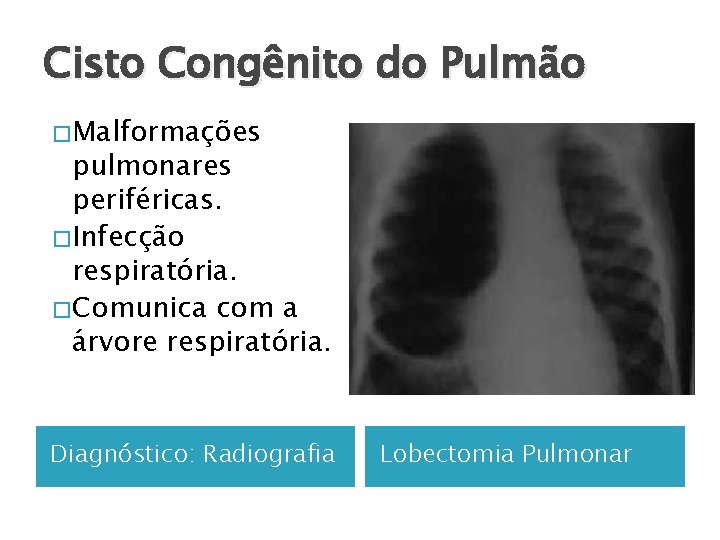 Cisto Congênito do Pulmão � Malformações pulmonares periféricas. � Infecção respiratória. � Comunica com