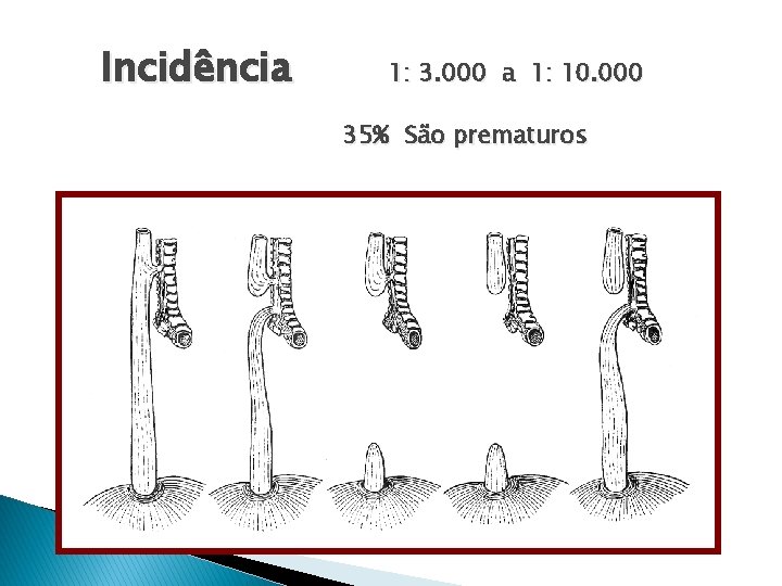 Incidência 1: 3. 000 a 1: 10. 000 35% São prematuros 
