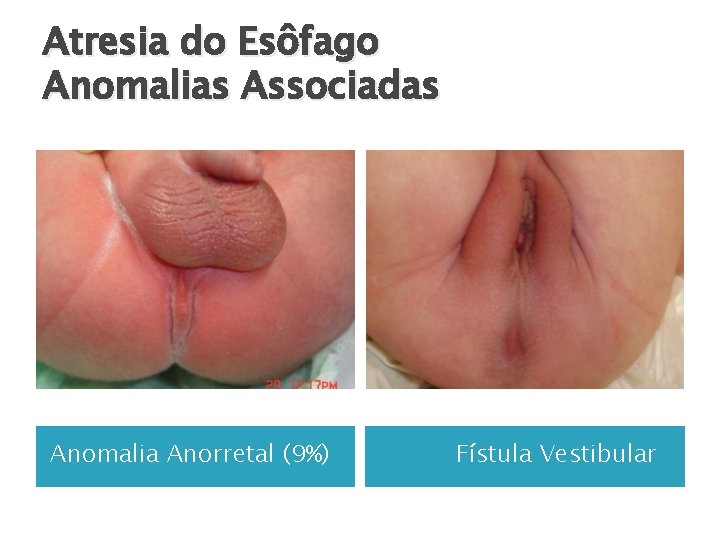 Atresia do Esôfago Anomalias Associadas Anomalia Anorretal (9%) Fístula Vestibular 