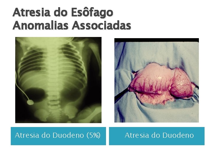 Atresia do Esôfago Anomalias Associadas Atresia do Duodeno (5%) Atresia do Duodeno 