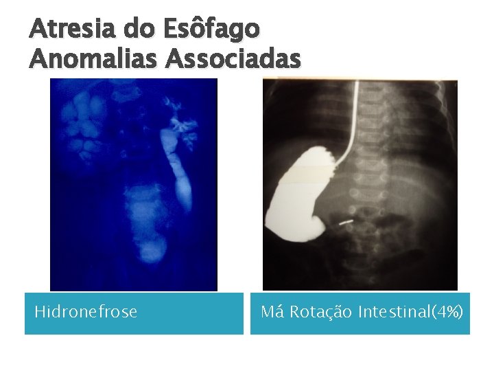 Atresia do Esôfago Anomalias Associadas Hidronefrose Má Rotação Intestinal(4%) 