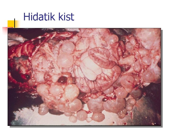 Hidatik kist 