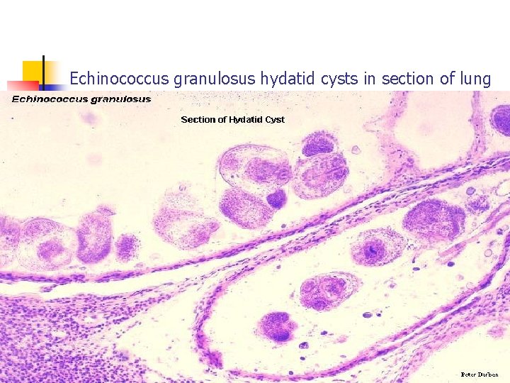 Echinococcus granulosus hydatid cysts in section of lung 