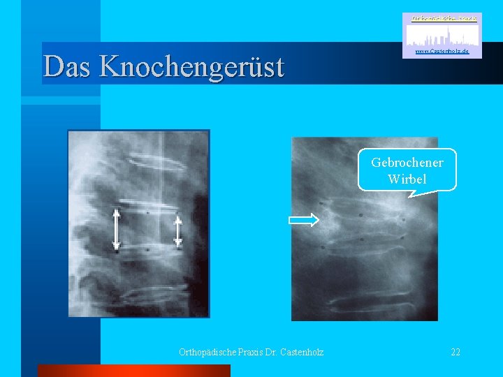 Orthopädische Praxis Das Knochengerüst www. Castenholz. de Gebrochener Wirbel Orthopädische Praxis Dr. Castenholz 22
