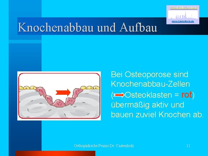 Orthopädische Praxis Knochenabbau und Aufbau www. Castenholz. de Bei Osteoporose sind Knochenabbau-Zellen ( Osteoklasten