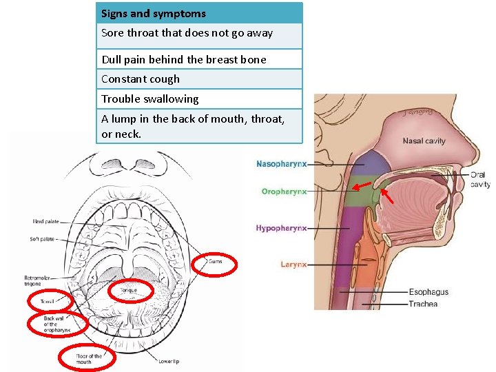 Signs and symptoms Sore throat that does not go away Dull pain behind the