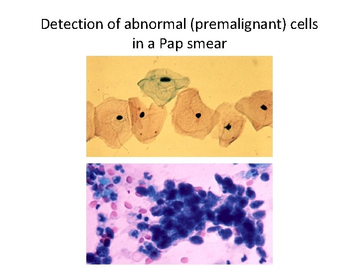 Detection of abnormal (premalignant) cells in a Pap smear 