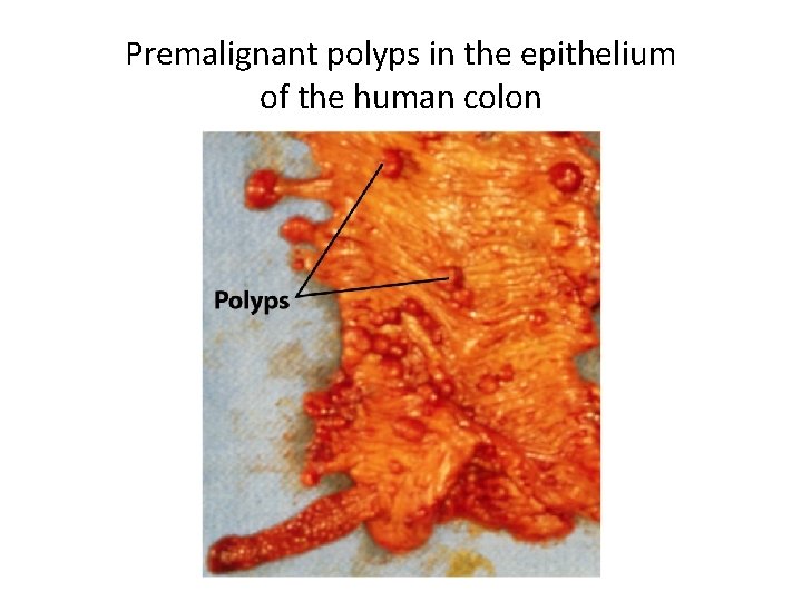 Premalignant polyps in the epithelium of the human colon 