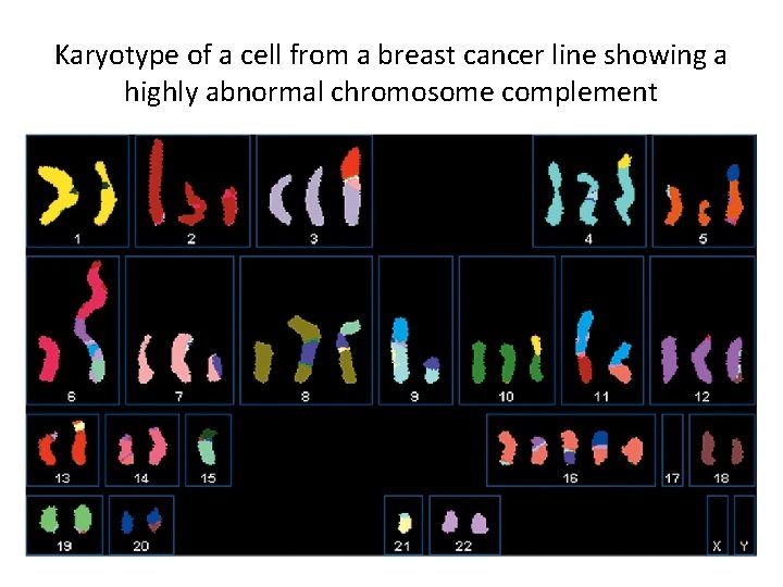 Karyotype of a cell from a breast cancer line showing a highly abnormal chromosome