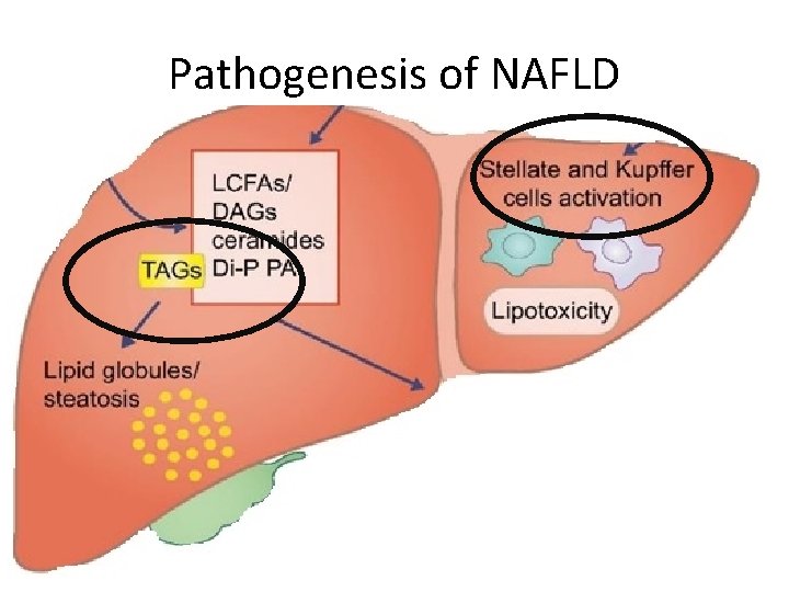 Pathogenesis of NAFLD 