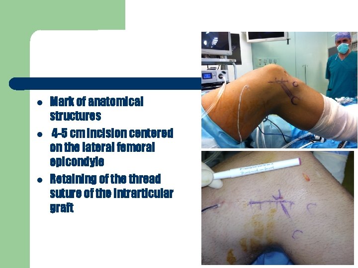  Mark of anatomical structures 4 -5 cm incision centered on the lateral femoral