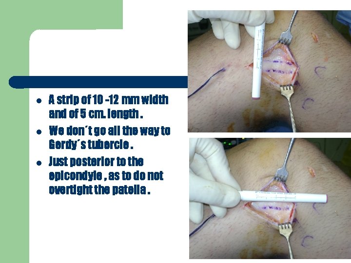  A strip of 10 -12 mm width and of 5 cm. length. We