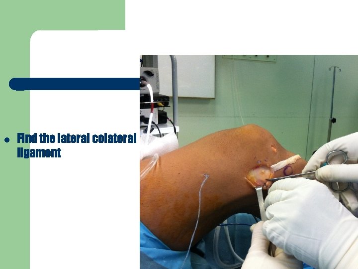  Find the lateral colateral ligament 