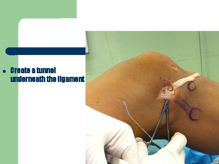  Create a tunnel underneath the ligament 