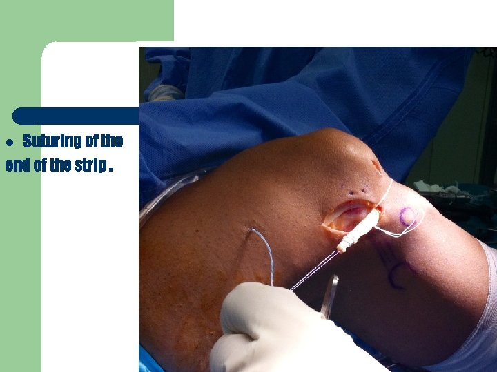 Suturing of the end of the strip. 