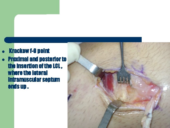  Krackow f-9 point Proximal and posterior to the insertion of the LCL ,