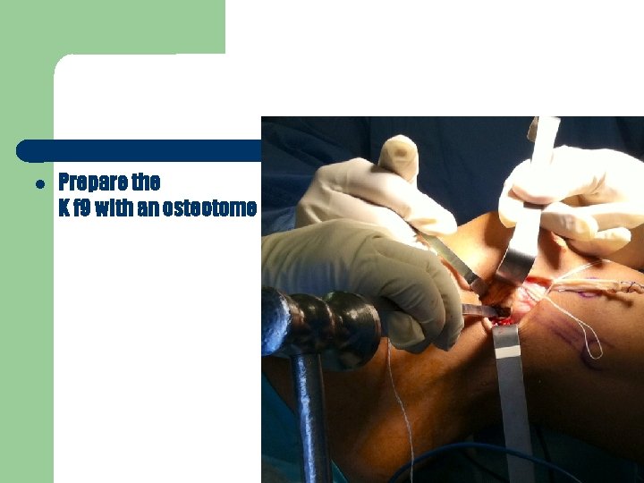 Prepare the K f 9 with an osteotome 