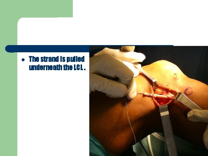  The strand is pulled underneath the LCL. 