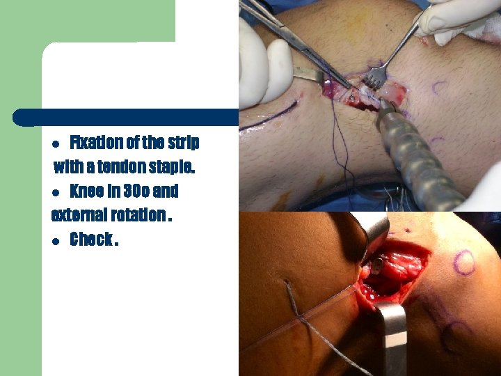 Fixation of the strip with a tendon staple. Knee in 30 o and external