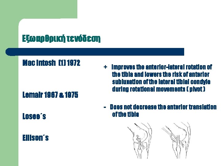Εξωαρθρική τενόδεση Mac Intosh (1) 1972 Lemair 1967 & 1975 Losee΄s Ellison΄s + improves