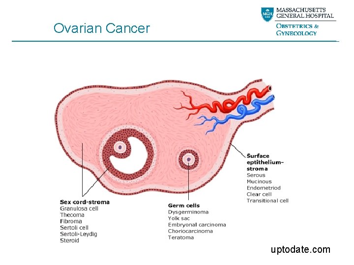 Ovarian Cancer uptodate. com 
