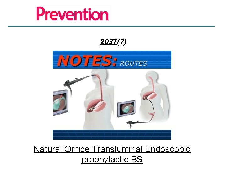 2037(? ) Natural Orifice Transluminal Endoscopic prophylactic BS 