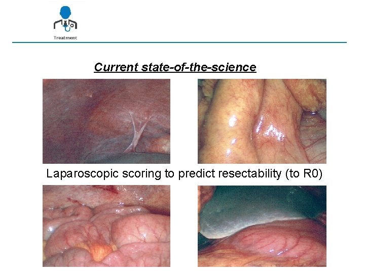 Current state-of-the-science Laparoscopic scoring to predict resectability (to R 0) 