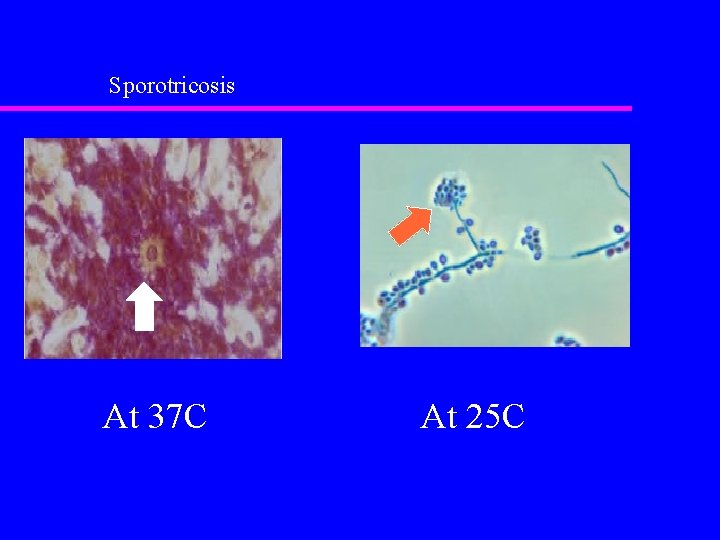 Sporotricosis At 37 C At 25 C 