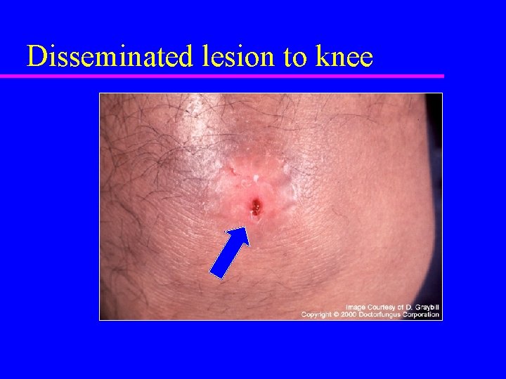 Disseminated lesion to knee 