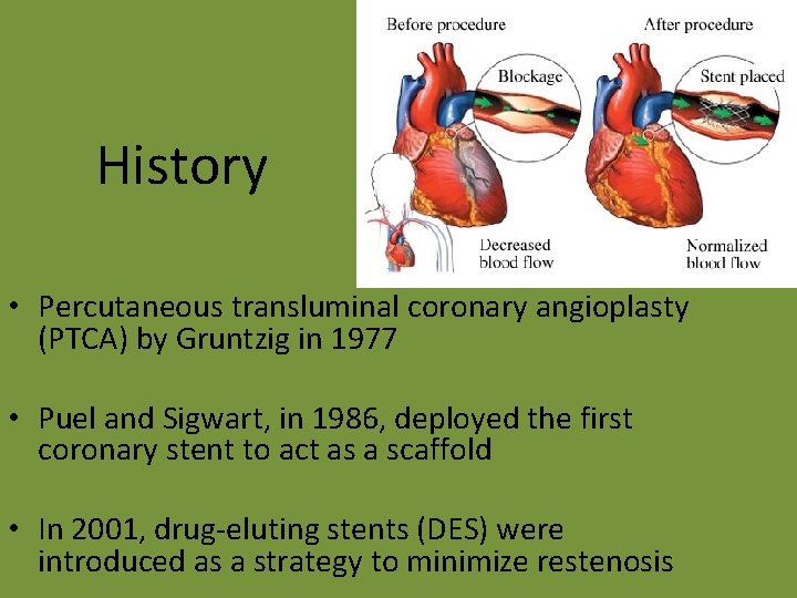 History • Percutaneous transluminal coronary angioplasty (PTCA) by Gruntzig in 1977 • Puel and
