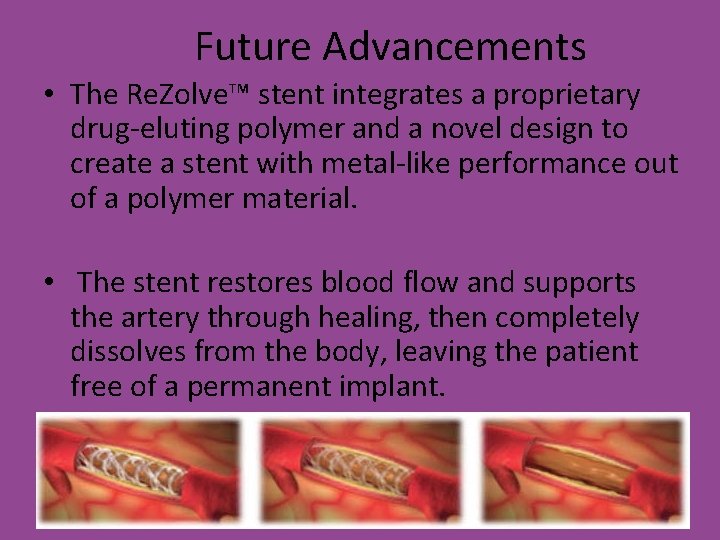 Future Advancements • The Re. Zolve™ stent integrates a proprietary drug-eluting polymer and a