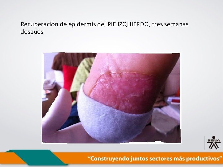 Recuperación de epidermis del PIE IZQUIERDO, tres semanas después 