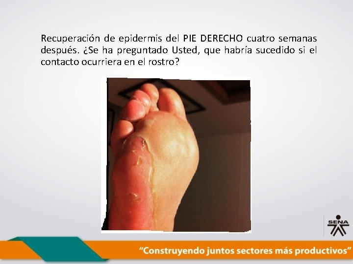 Recuperación de epidermis del PIE DERECHO cuatro semanas después. ¿Se ha preguntado Usted, que