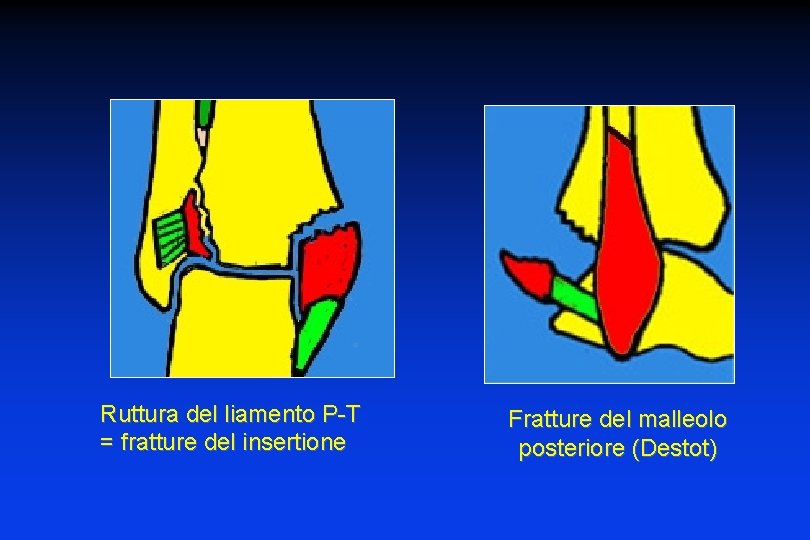 Ruttura del liamento P-T = fratture del insertione Fratture del malleolo posteriore (Destot) 