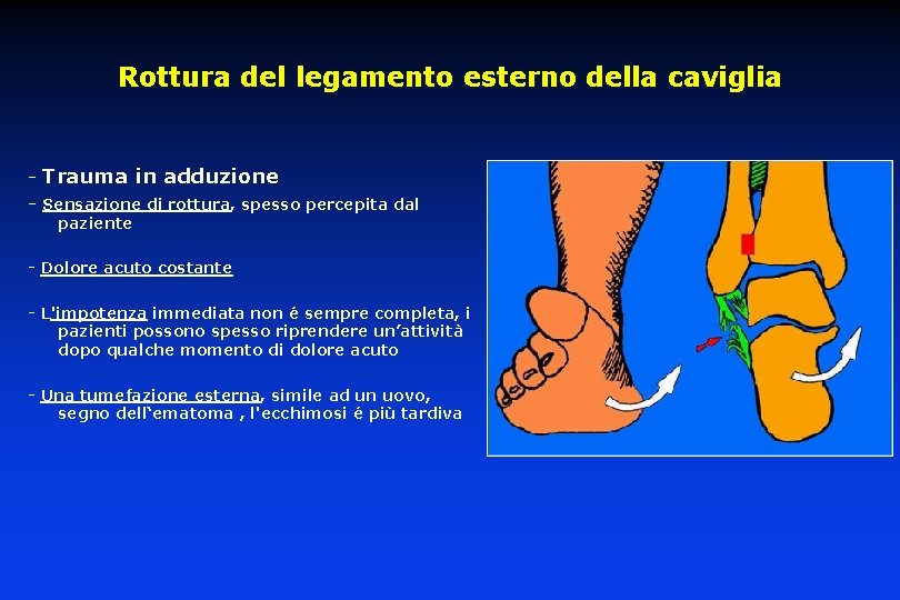 Rottura del legamento esterno della caviglia - Trauma in adduzione - Sensazione di rottura,