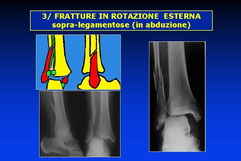 3/ FRATTURE IN ROTAZIONE ESTERNA sopra-legamentose (in abduzione) 