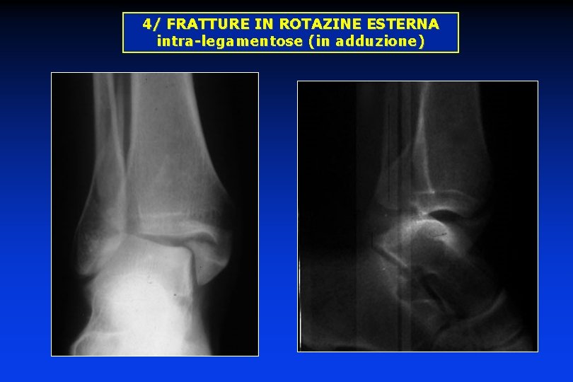 4/ FRATTURE IN ROTAZINE ESTERNA intra-legamentose (in adduzione) 