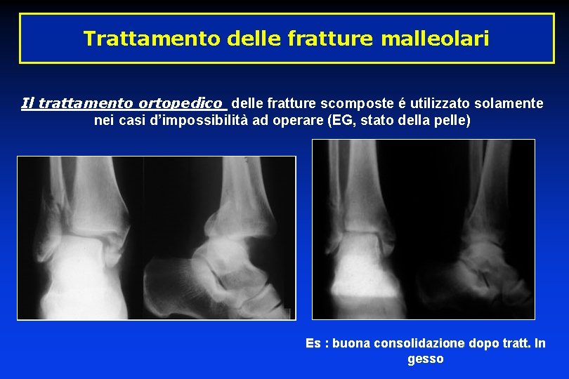 Trattamento delle fratture malleolari Il trattamento ortopedico delle fratture scomposte é utilizzato solamente nei