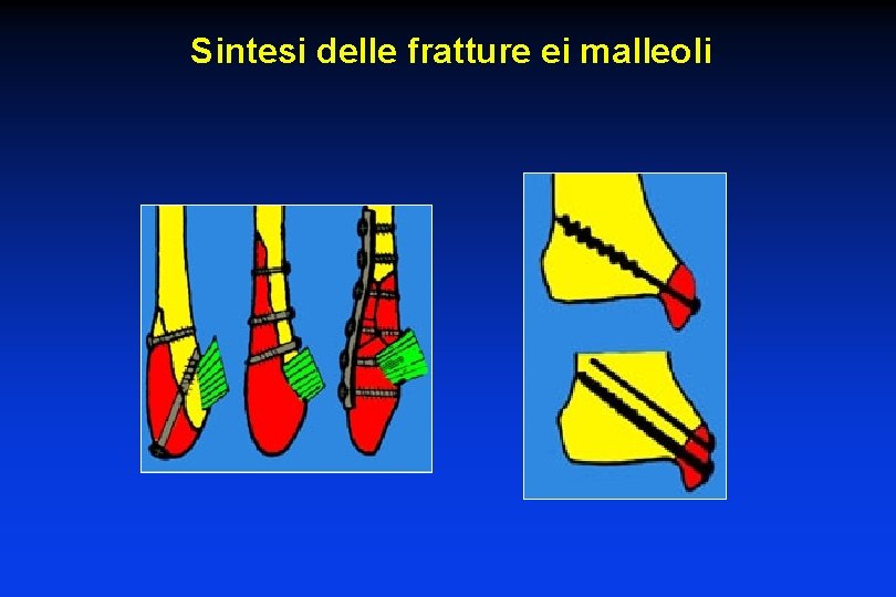 Sintesi delle fratture ei malleoli 