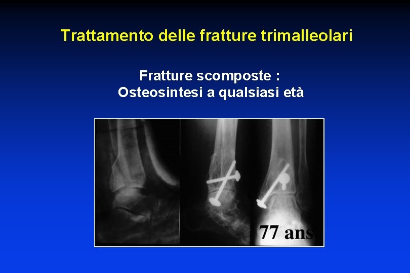 Trattamento delle fratture trimalleolari Fratture scomposte : Osteosintesi a qualsiasi età 